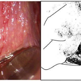 Bazooka reccomend Cluster of bumps on vagina