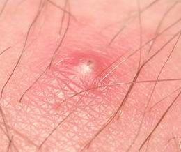 Pimple vulva