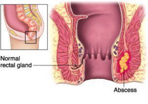 Pus near the anus