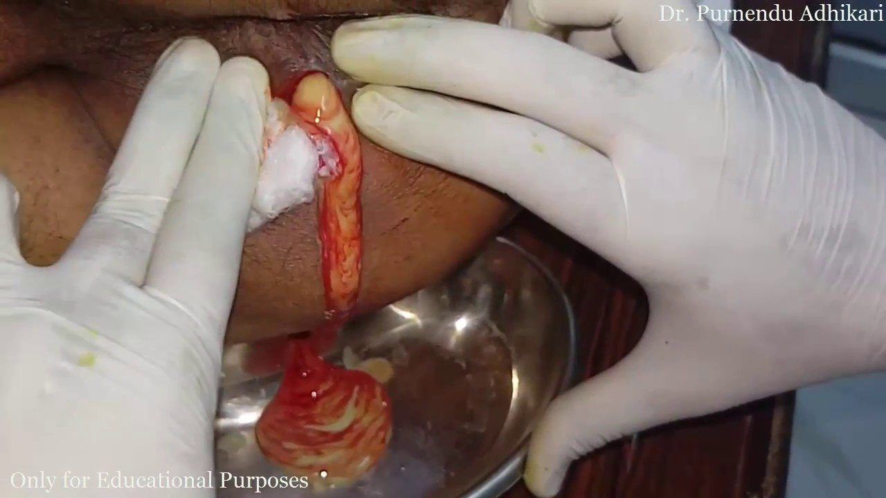 Pus near the anus