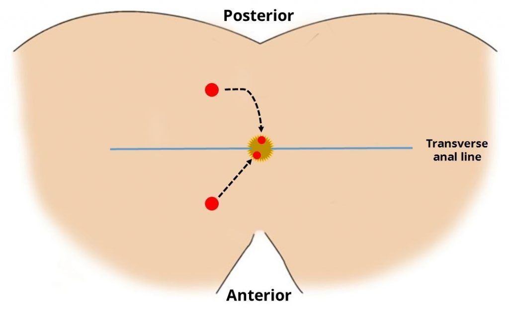 Anal fistula diabetes