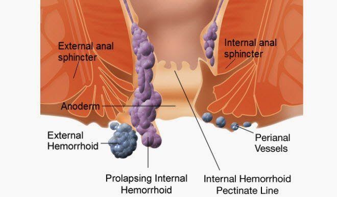 best of Warts homeopathic remedy Anal