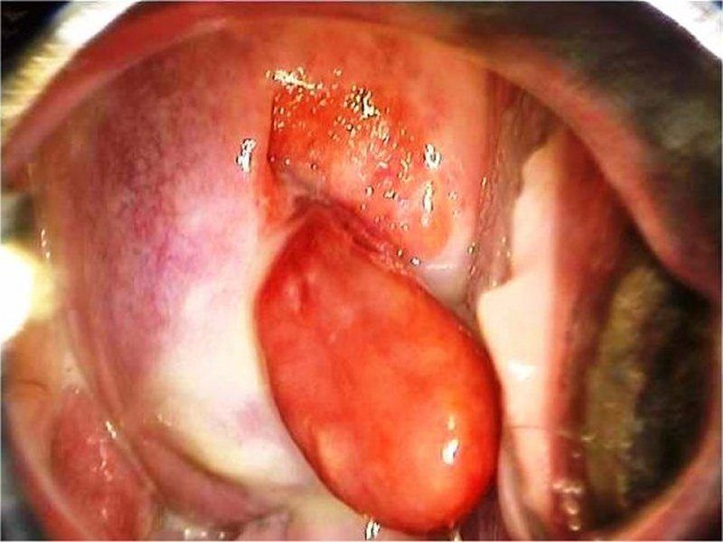 best of Vagina polyp Epithelial