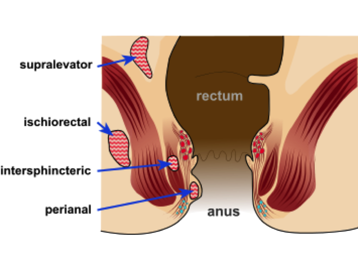 Anal fistula diabetes