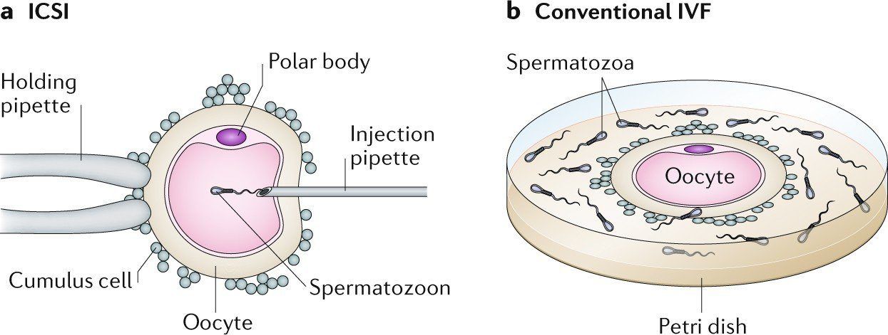 best of Chromosomal Tesa abnormalities sperm tese