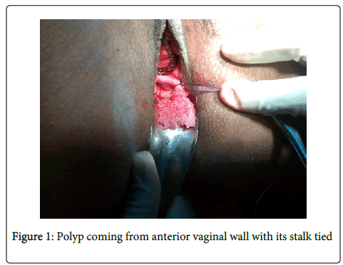 Epithelial vagina polyp