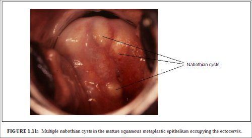 Jam J. reccomend Epithelial vagina polyp