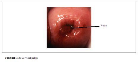 Epithelial vagina polyp