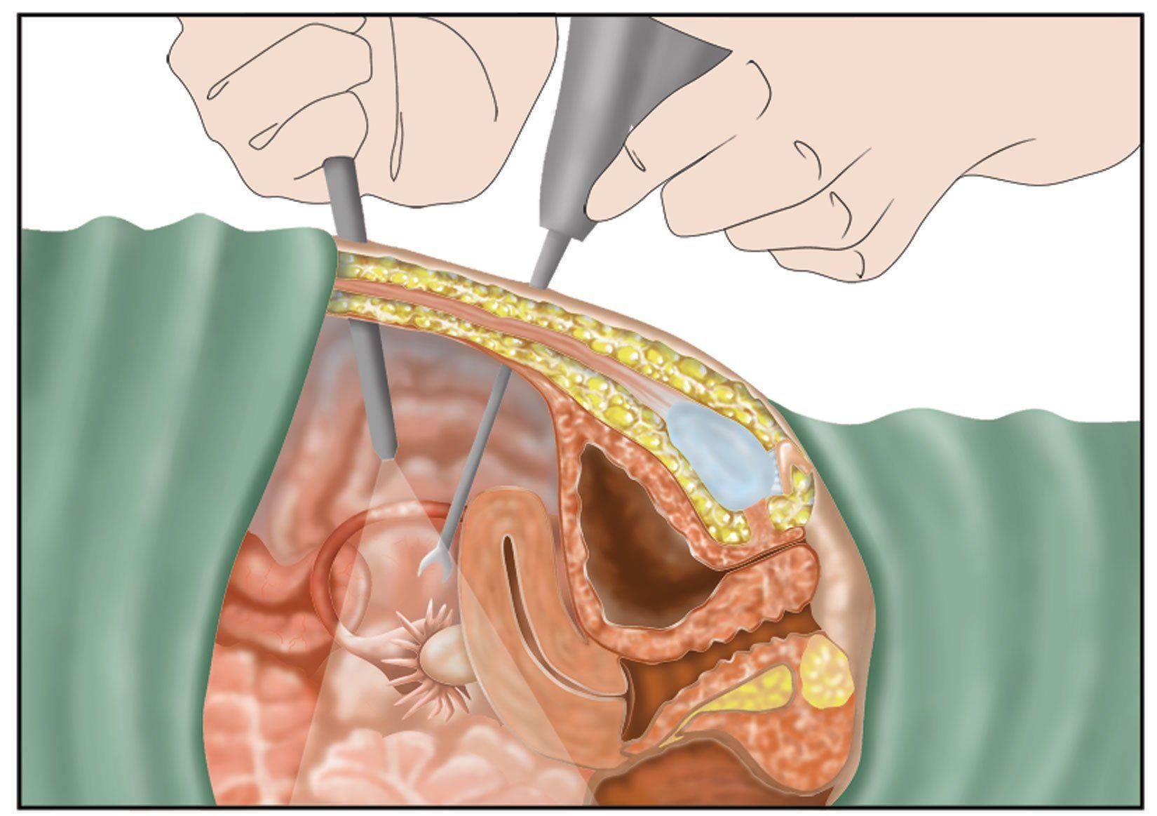 Ladybug reccomend Pain in lower stomach after sex